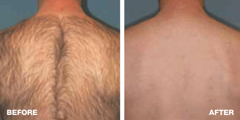 GentleMax Pro Hair Removal | Laser Away