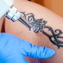 Tattoo removal in Winnipeg